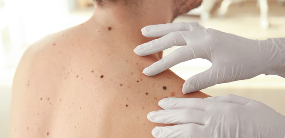 A health care worker's hands with vinyl gloves on are on a man's shoulder where there are various moles of different sizes and colors.