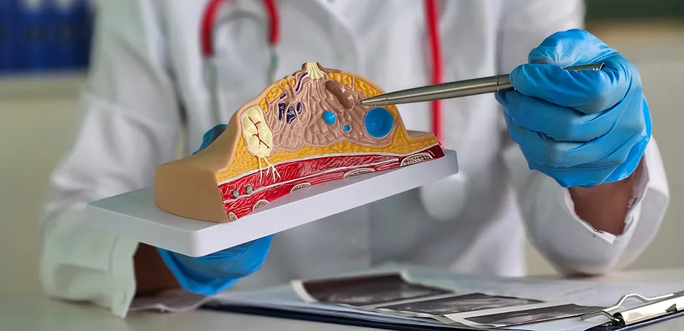 A doctor is pointing out cancer growths on a model of a breast.